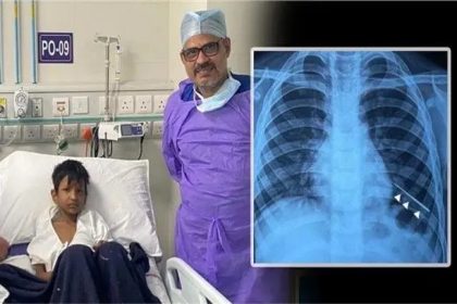 ಬಾಲಕನ ಶ್ವಾಸಕೋಶದಲ್ಲಿ ಸೂಜಿ ಪತ್ತೆ!