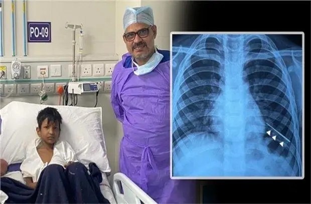 ಬಾಲಕನ ಶ್ವಾಸಕೋಶದಲ್ಲಿ ಸೂಜಿ ಪತ್ತೆ!