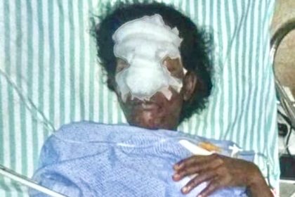 ಹೂ ಕಿತ್ತಿದ್ದಕ್ಕೆ ಅಂಗನವಾಡಿ ಸಹಾಯಕಿಯ ಮೂಗು ಕತ್ತರಿಸಿದ ರಾಕ್ಷಸ!