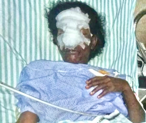 ಹೂ ಕಿತ್ತಿದ್ದಕ್ಕೆ ಅಂಗನವಾಡಿ ಸಹಾಯಕಿಯ ಮೂಗು ಕತ್ತರಿಸಿದ ರಾಕ್ಷಸ!