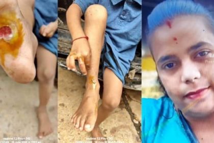 ಕಾದ ಕಬ್ಬಿಣದ ಸಲಾಕೆಯಿಂದ ಮಗುವಿಗೆ ಬರೆ ಹಾಕಿದ ತಾಯಿ