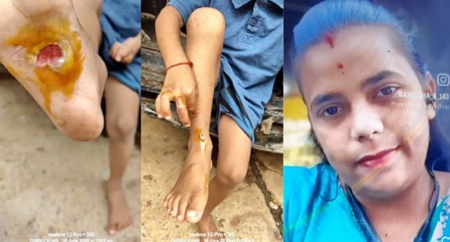 ಕಾದ ಕಬ್ಬಿಣದ ಸಲಾಕೆಯಿಂದ ಮಗುವಿಗೆ ಬರೆ ಹಾಕಿದ ತಾಯಿ